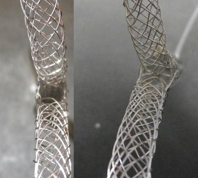 Flechten-Stents.jpg